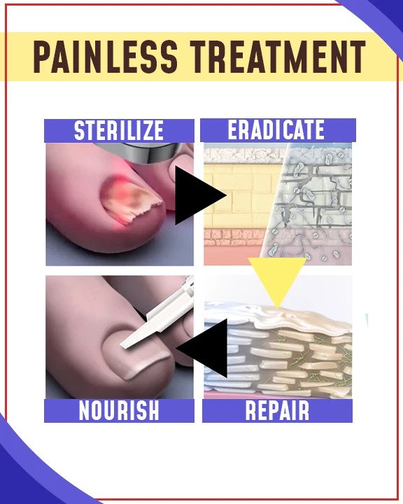 Setovi za liječenje plavim svjetlom protiv gljivica - Image 2