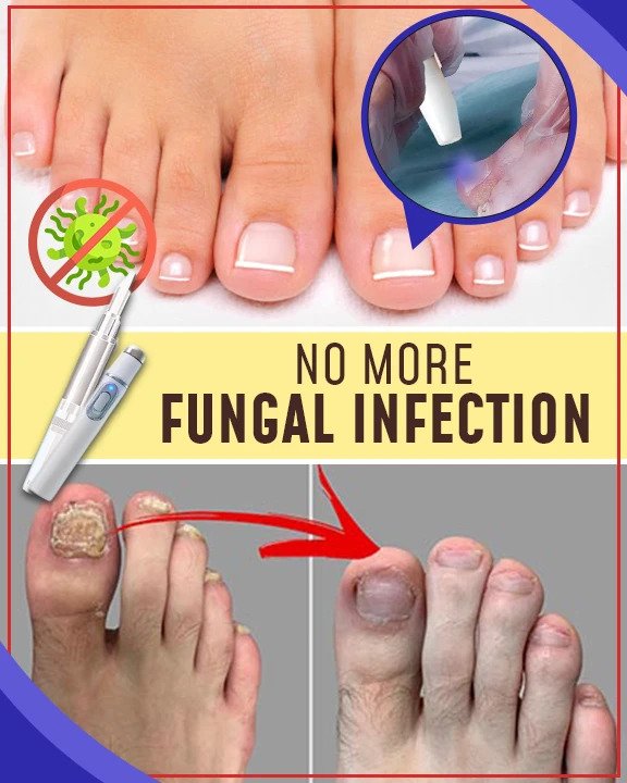 Setovi za liječenje plavim svjetlom protiv gljivica - Image 3