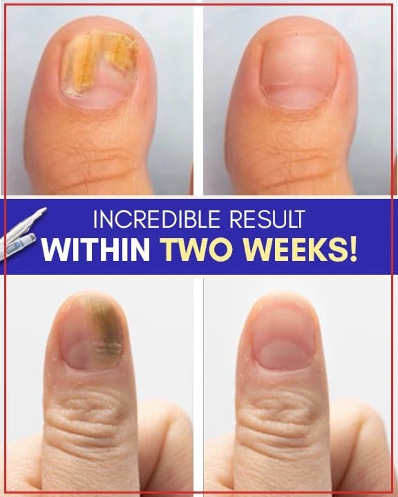 Setovi za liječenje plavim svjetlom protiv gljivica - Image 5